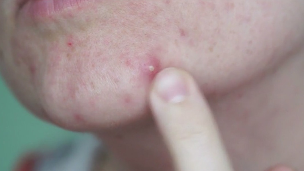 Dr. Pimple Popper clears up myths about adult acne