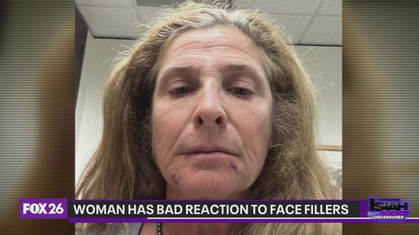 Woman says she has bad reaction to face fillers