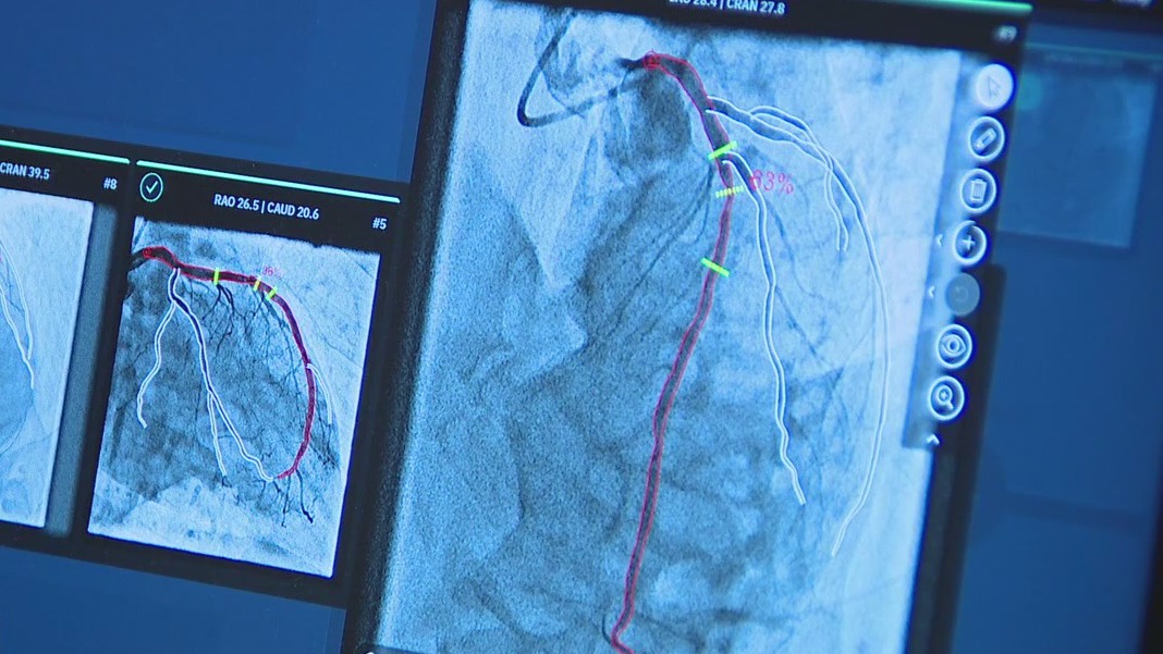 AI technology used for heart surgery