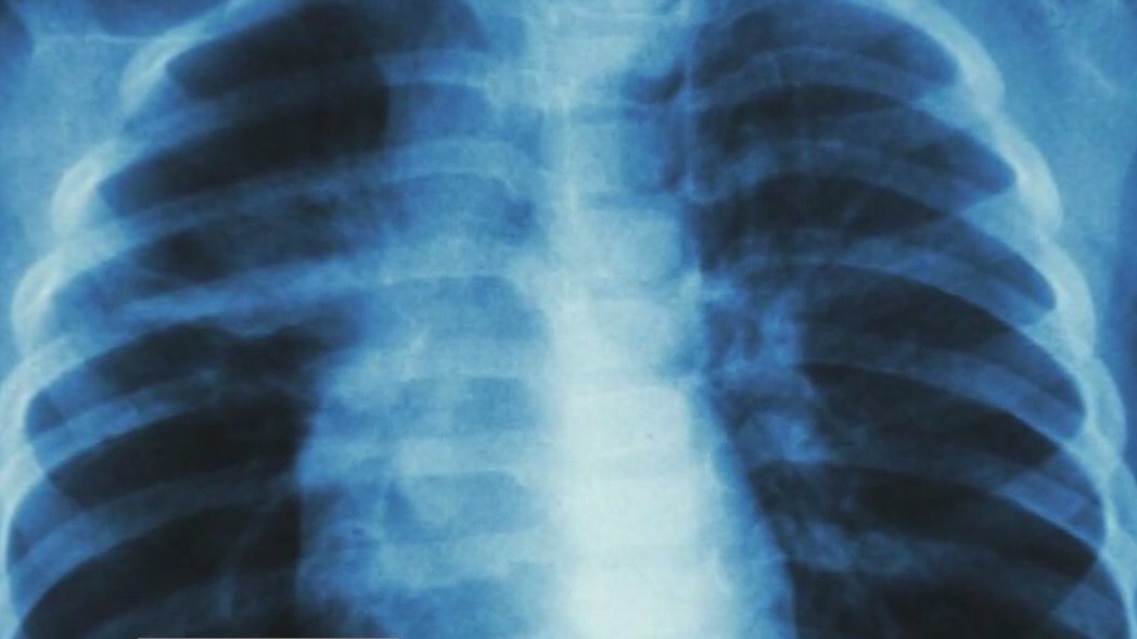 Tuberculosis cases on the rise for third straight year