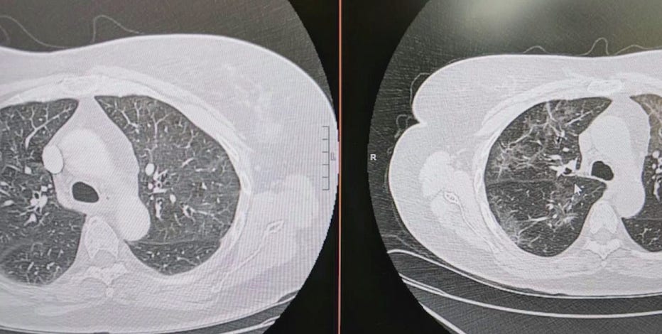 COVID-19 long haulers share experiences of inhalers, hazy lung X-rays