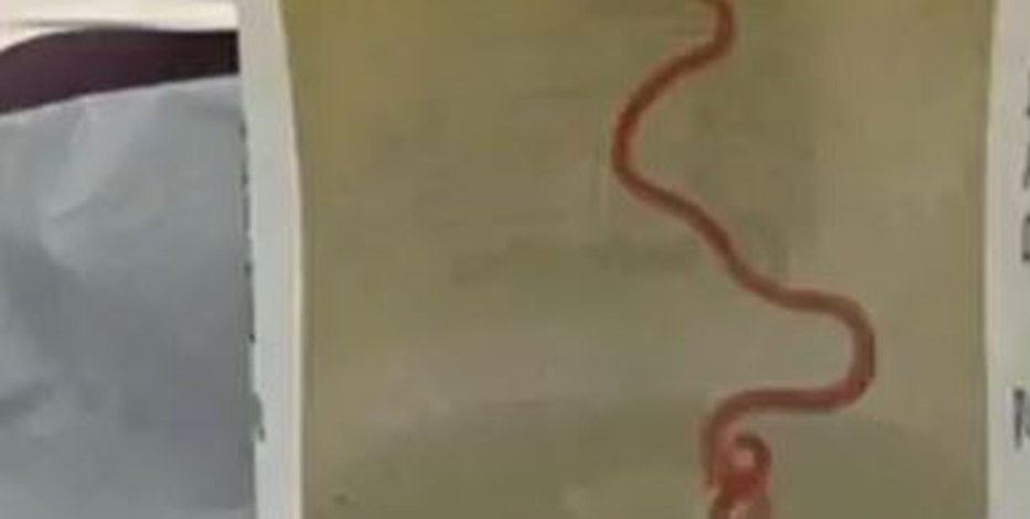 Neurosurgeon probing patient’s mystery symptoms plucks worm from woman’s brain in Australia