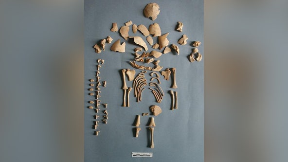 Down syndrome identified in prehistoric bones of infants through DNA
