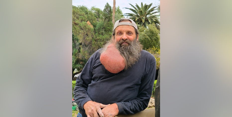 Giant tumor growing for decades removed from neck area of Scottsdale man