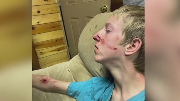 Family comes to rescue of 15-year-old attacked by a bear in Apline