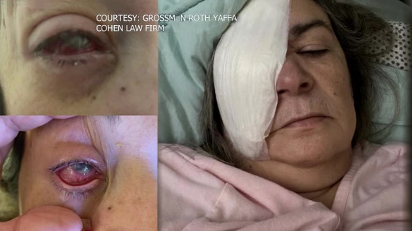 Eye drops nightmare: South Florida woman loses eye after using artificial tears