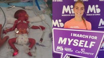 March of Dimes miracle baby born 3 months premature grows up with desire to help children