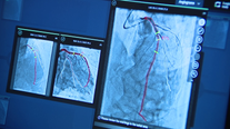 Bay Area hospital using AI technology for new cardiac procedure