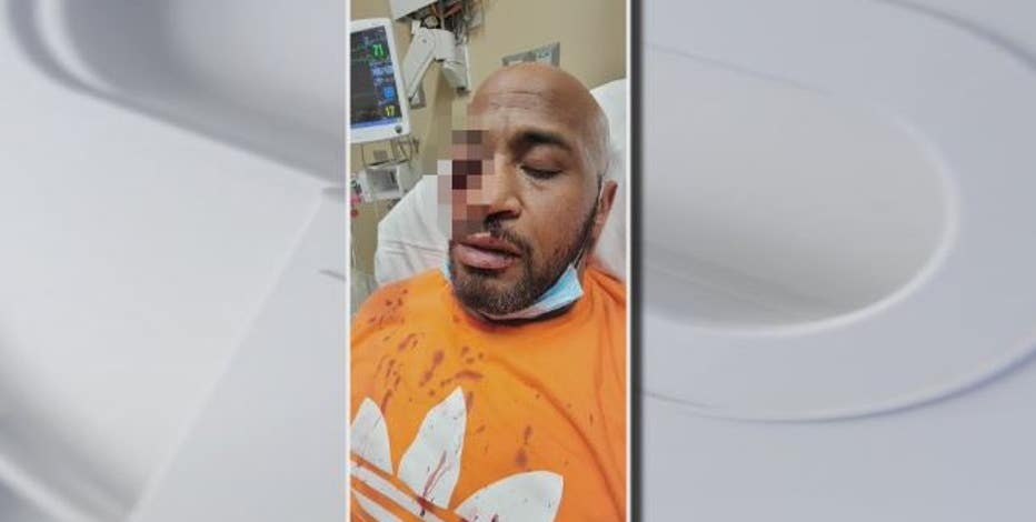 'I'm in total disbelief,' says Houston man punched so hard doctors had to remove an eye