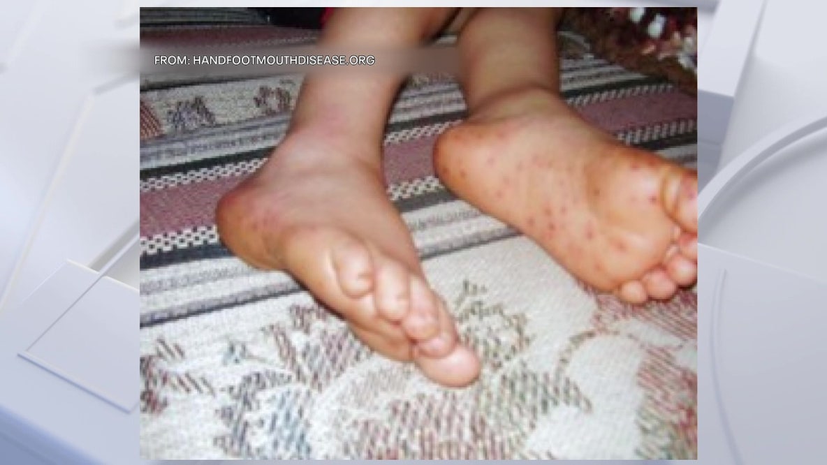 Hand-Foot-and-Mouth Disease on the rise: How parents can protect their children