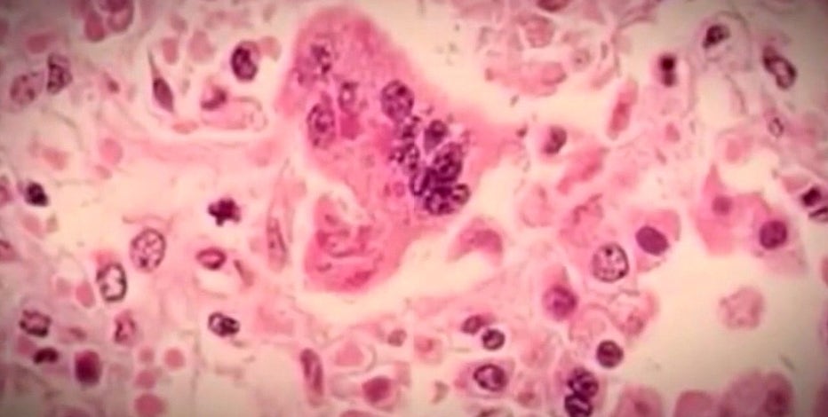 Measles in Michigan: 3 total cases reported by health officials