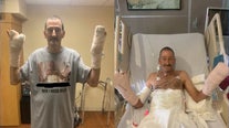 Florida man who lost most of his fingers in fireworks explosion opens up about life-changing accident