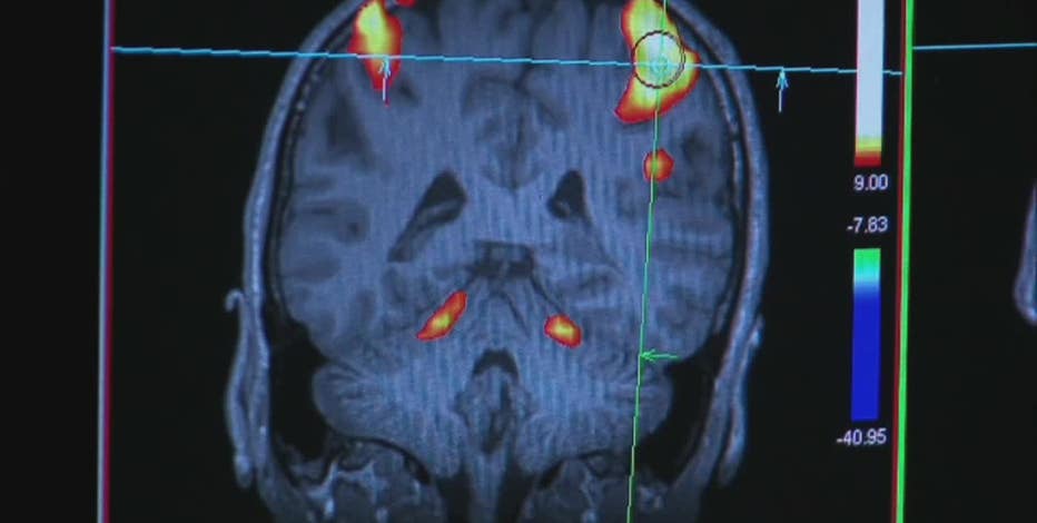 Groundbreaking Alzheimer's research in North Texas receives massive new grant