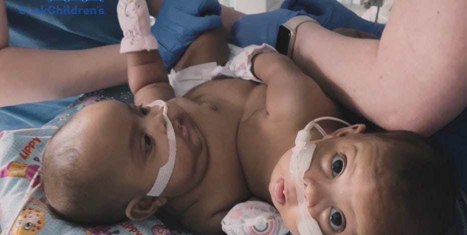 Conjoined twins separated at Cook Children's Medical Center