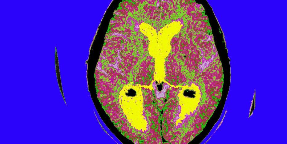 Alzheimer's prevention trial at Georgetown, Howard, Johns Hopkins