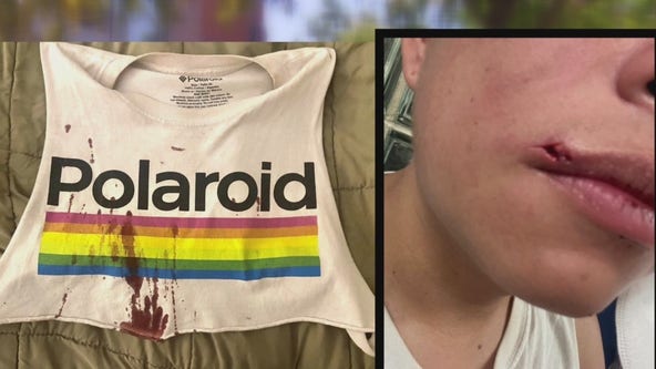 Gay couple attacked, accused of having monkeypox in Northwest DC
