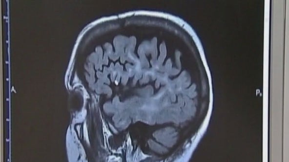 Doctors seeing more stroke patients under 65