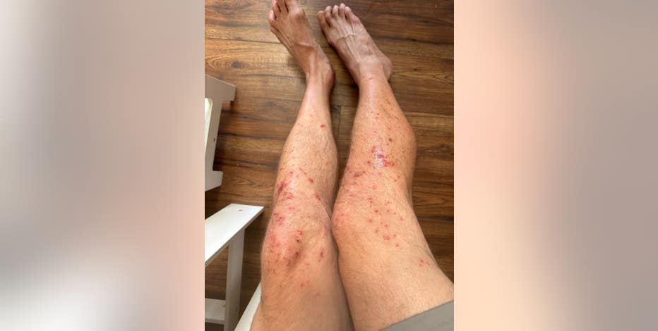Tough Mudder athletes complain of rash after Sonoma County race