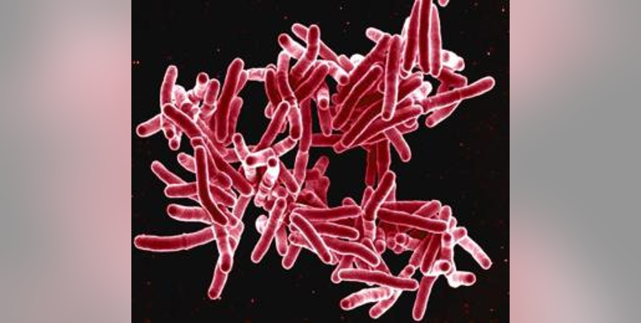 DOH: Tuberculosis cases rising in Washington state
