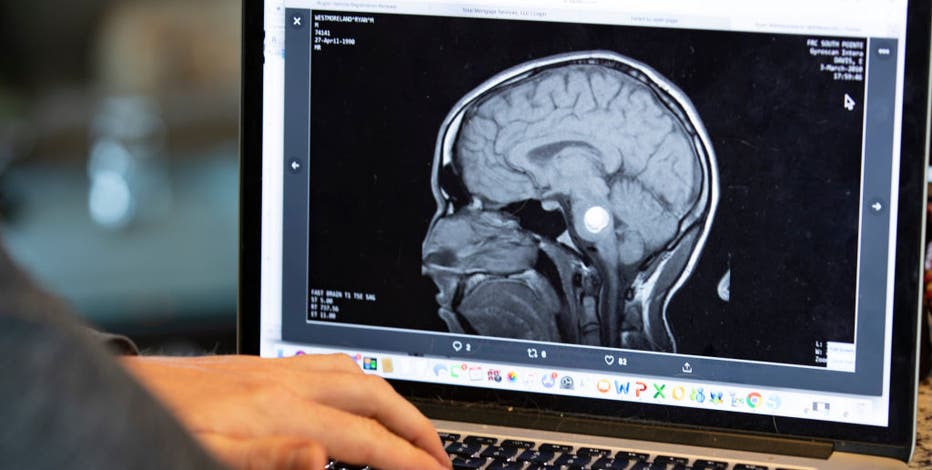 Healthy Living: Know the warning signs of stroke