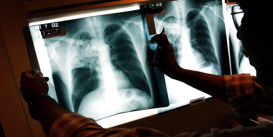 Inmates, families concerned about a prison's response to a major tuberculosis outbreak