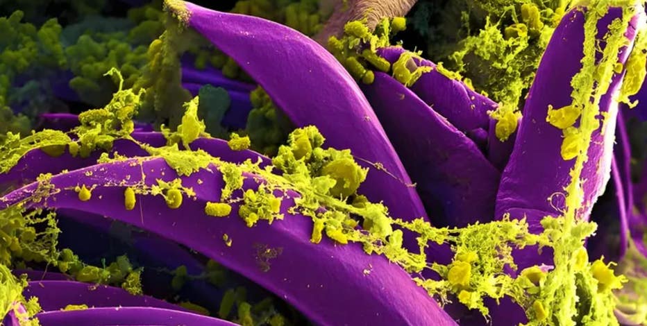 Oregon health officials confirm first human bubonic plague case since 2015