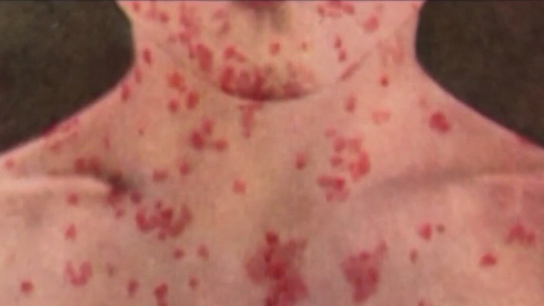 Possible measles exposure at East Bay restaurant