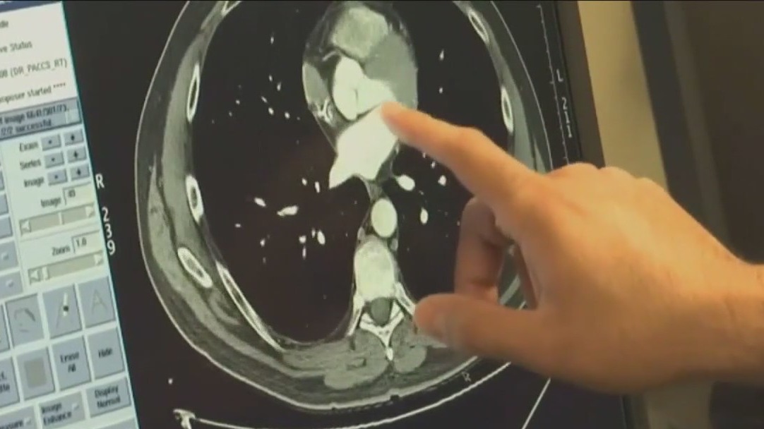 New study to examine lung cancer in Chicago-area millennials