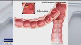 The Doctor Is In: Colorectal Cancer Screening