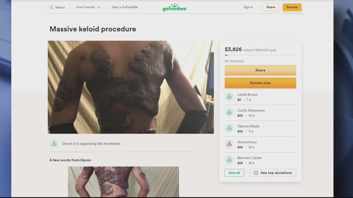 Man's keloid scarring taking over his body, but surgical procedure deemed cosmetic by insurance