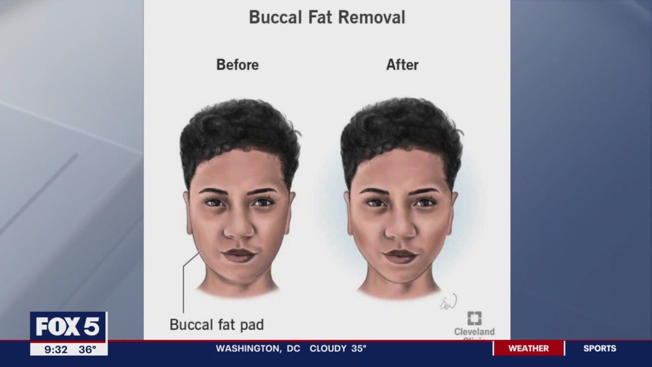 Buccal Fat Pad Removal Bethesda  Buccal Fat Pad Removal in Maryland