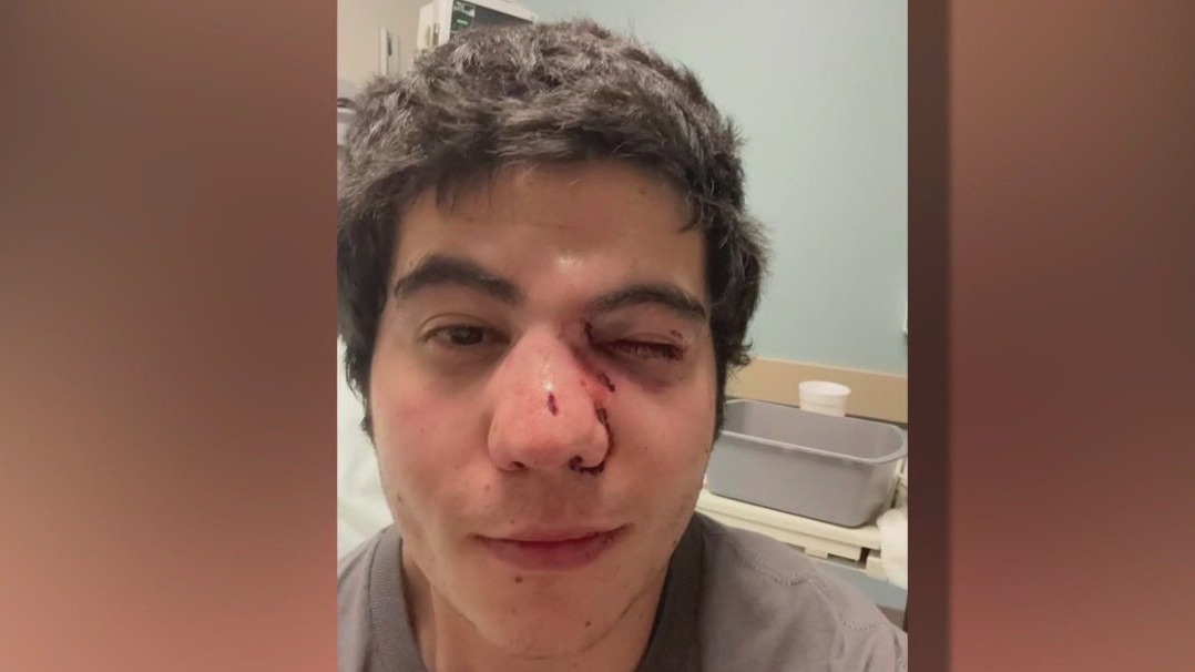 Man brutally attacked at random near Barton Springs; suspect at large