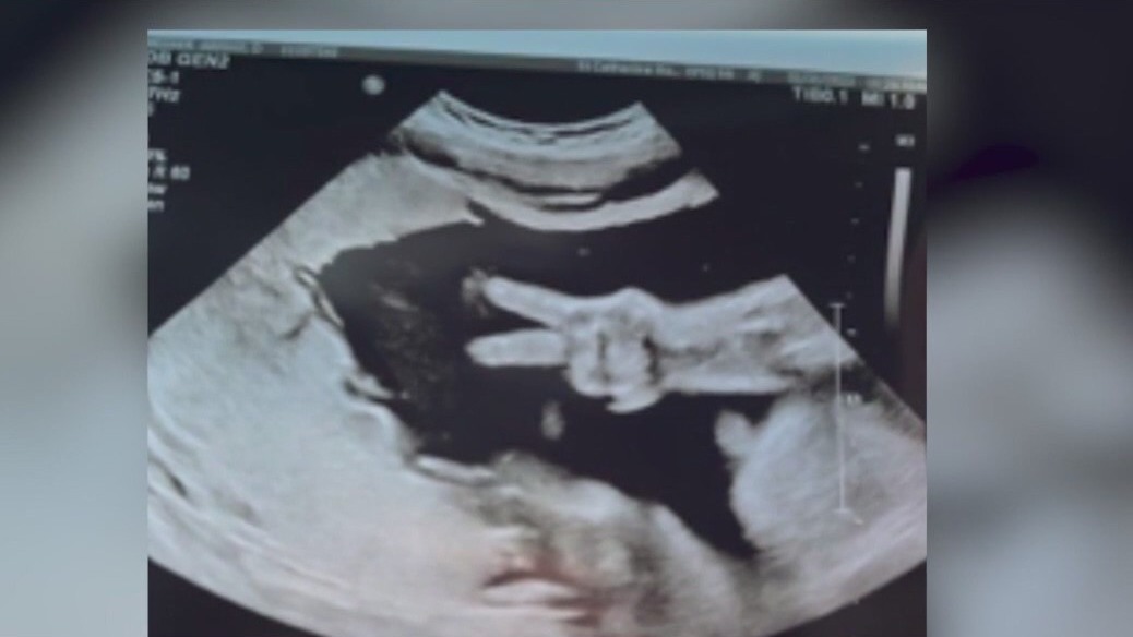 Ultrasound photo of baby giving 'peace sign' goes viral