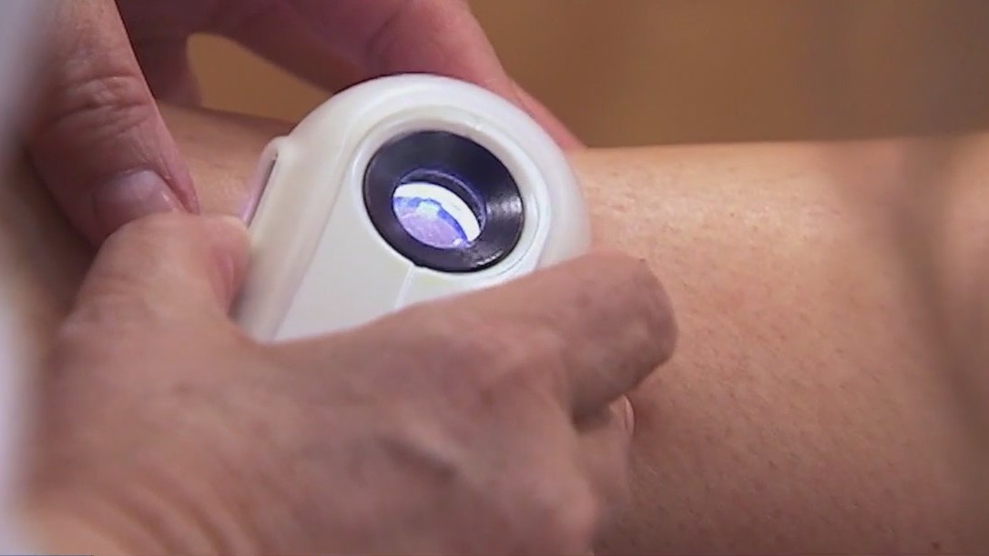 How to prepare for skin cancer screening