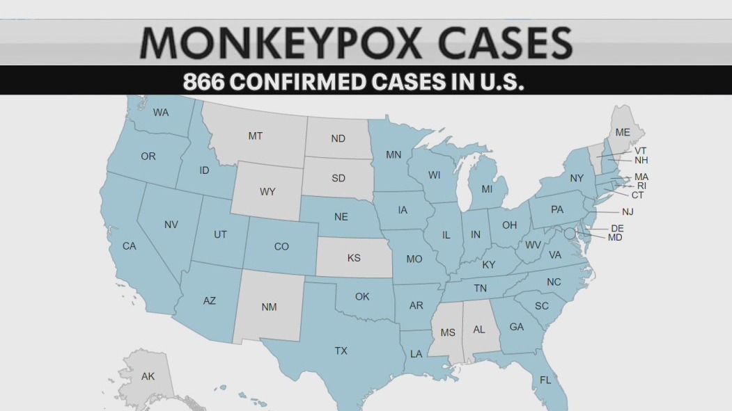 Monkeypox: 1st case in Milwaukee resident, health officials say