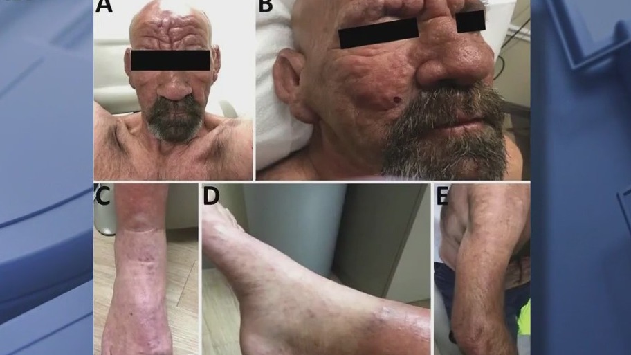 Leprosy an 'endemic' to Central Florida: CDC