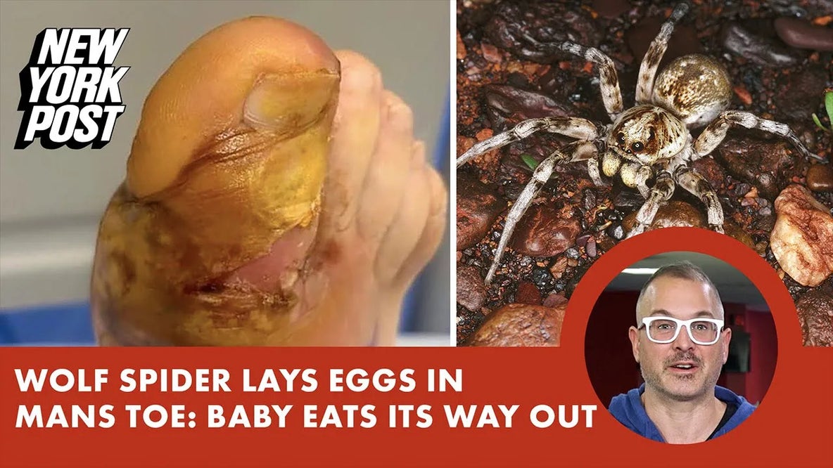 Wolf spider lays eggs in man’s toe