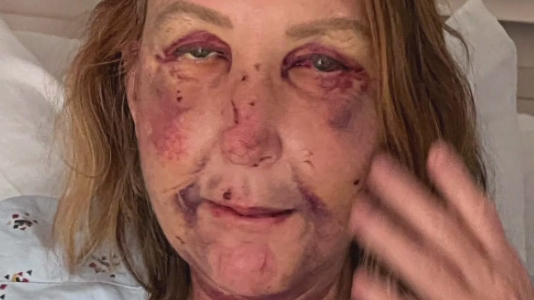 Woman's mouth wired shut after brutal attack