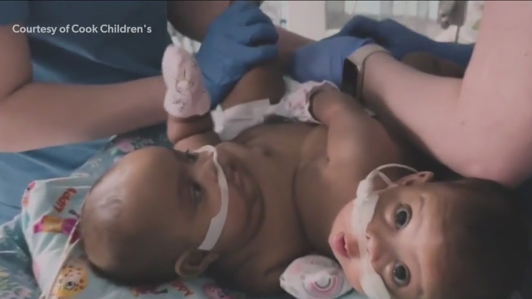 Conjoined baby twins successfully seperated