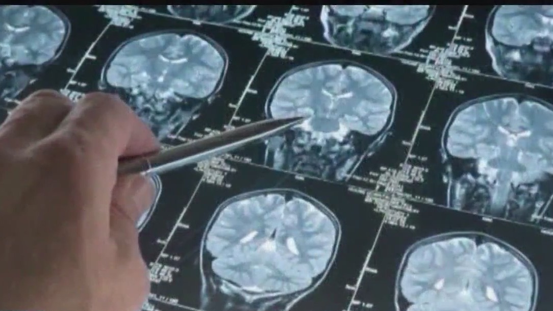 Study: Retired NFL players with history of concussions have reduced cognitive performance