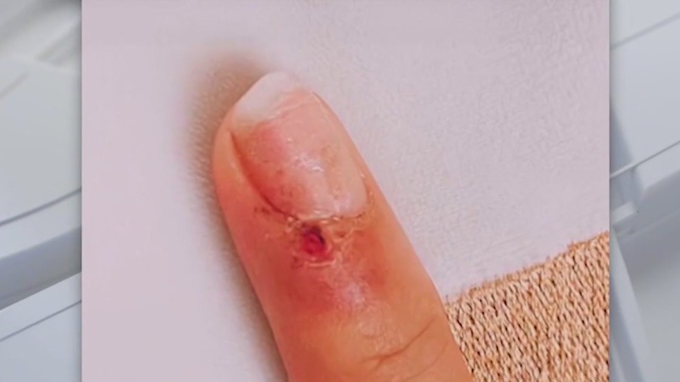 How an injury from a manicure triggered this woman's skin cancer