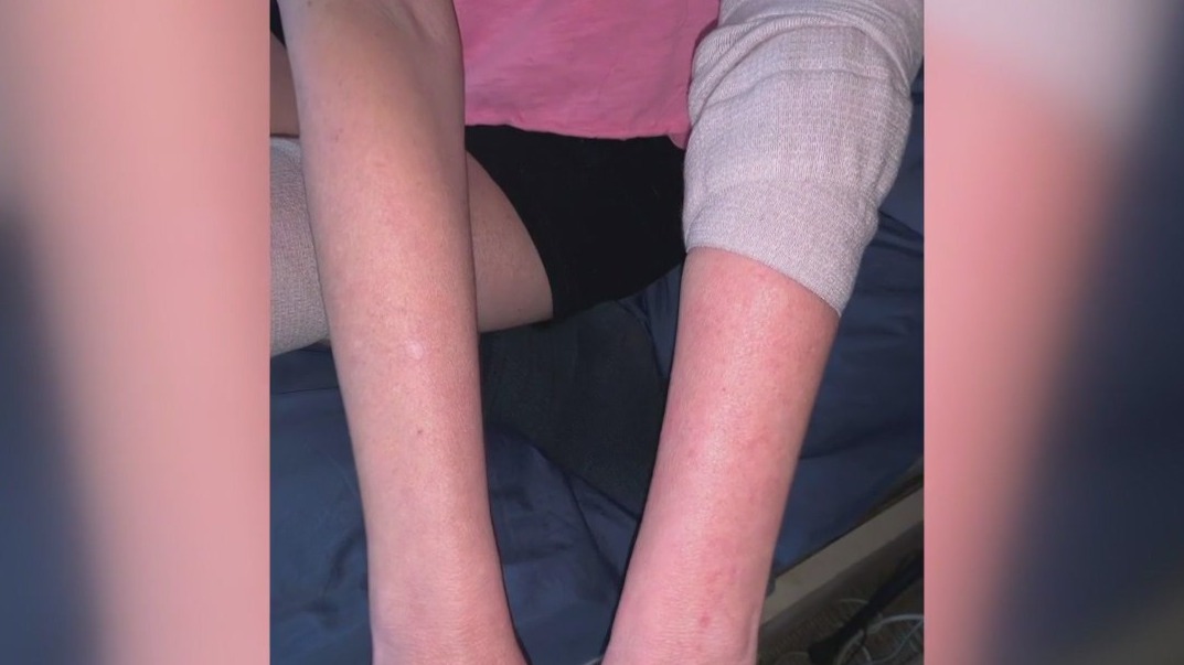 Woman describes living with CRPS