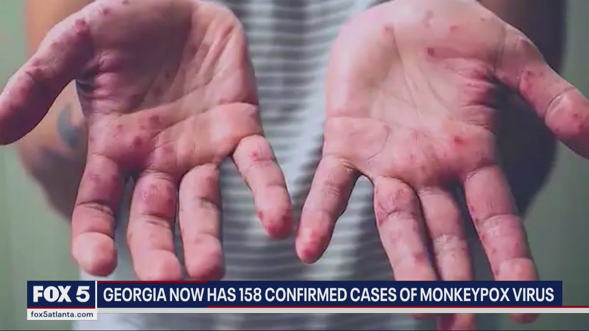 Georgia now has 158 confirmed cases of monkeypox virus