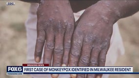 First case of monkeypox in Milwaukee resident