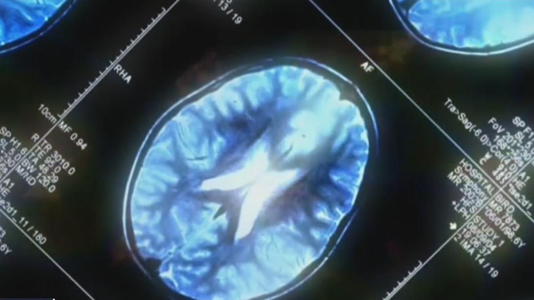 Experimental Alzheimer's drug shows promise, experts say