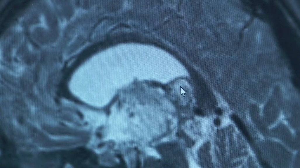 MN teen has brain tumor removed in 12-hour procedure