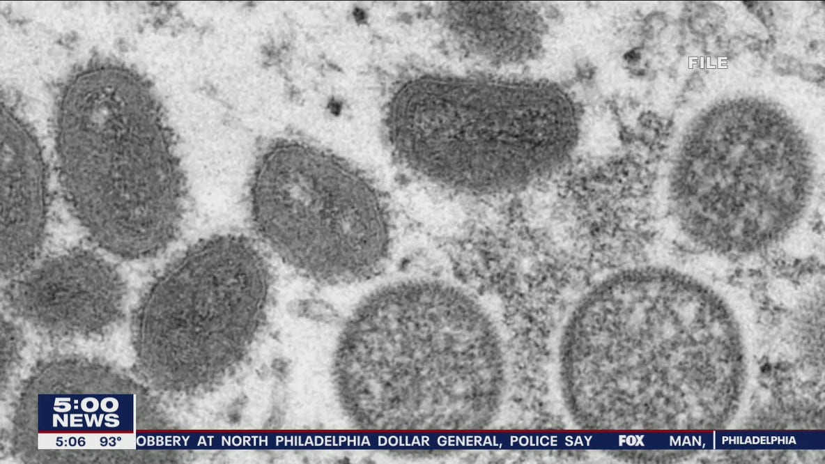 Local communities, leadership raise concerns about spread of Monkeypox