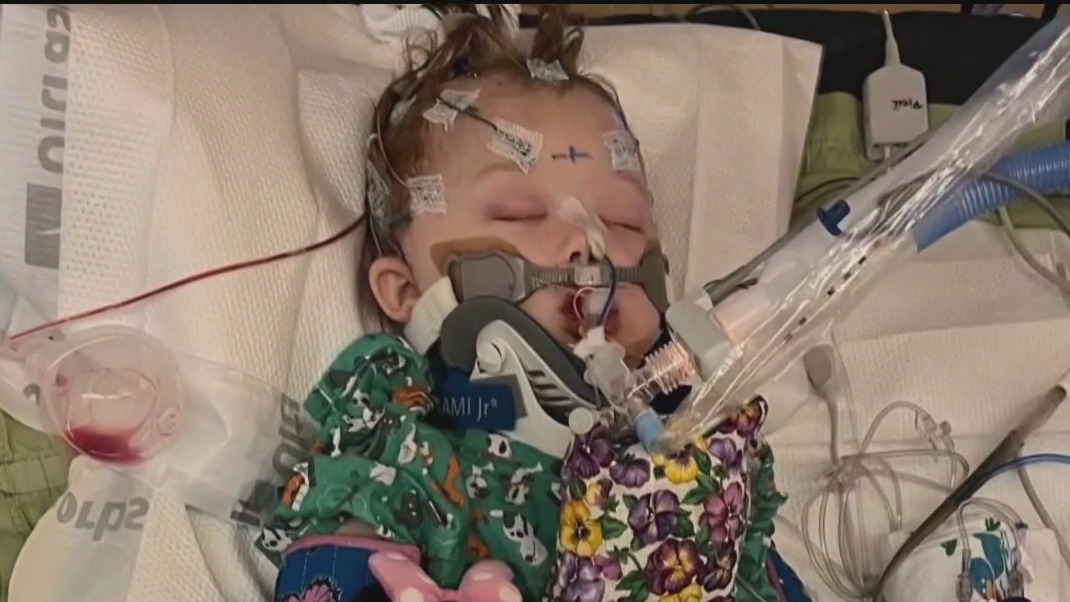3-year-old in coma after wrong-way crash