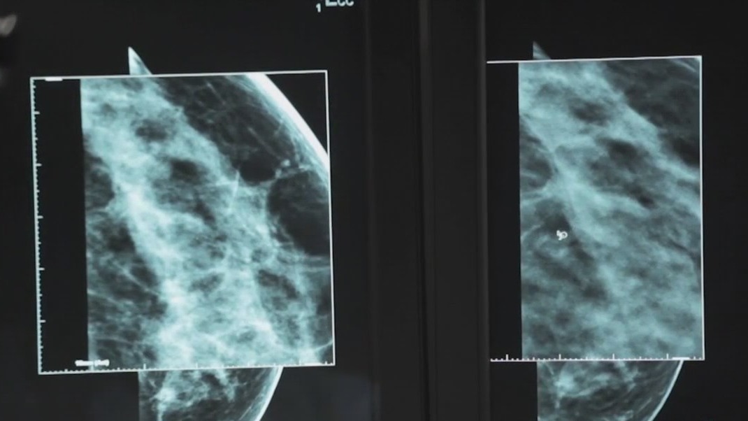 Clinical trials helping breast cancer patients