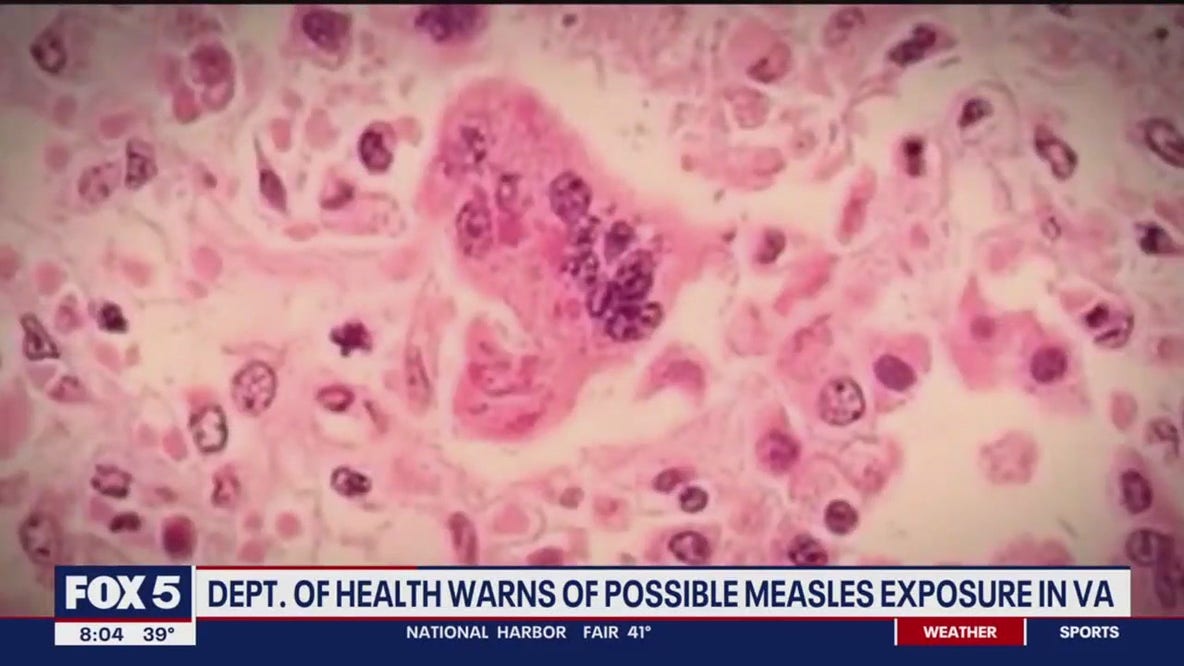 Department of Health warns of possible measles exposure in Virginia